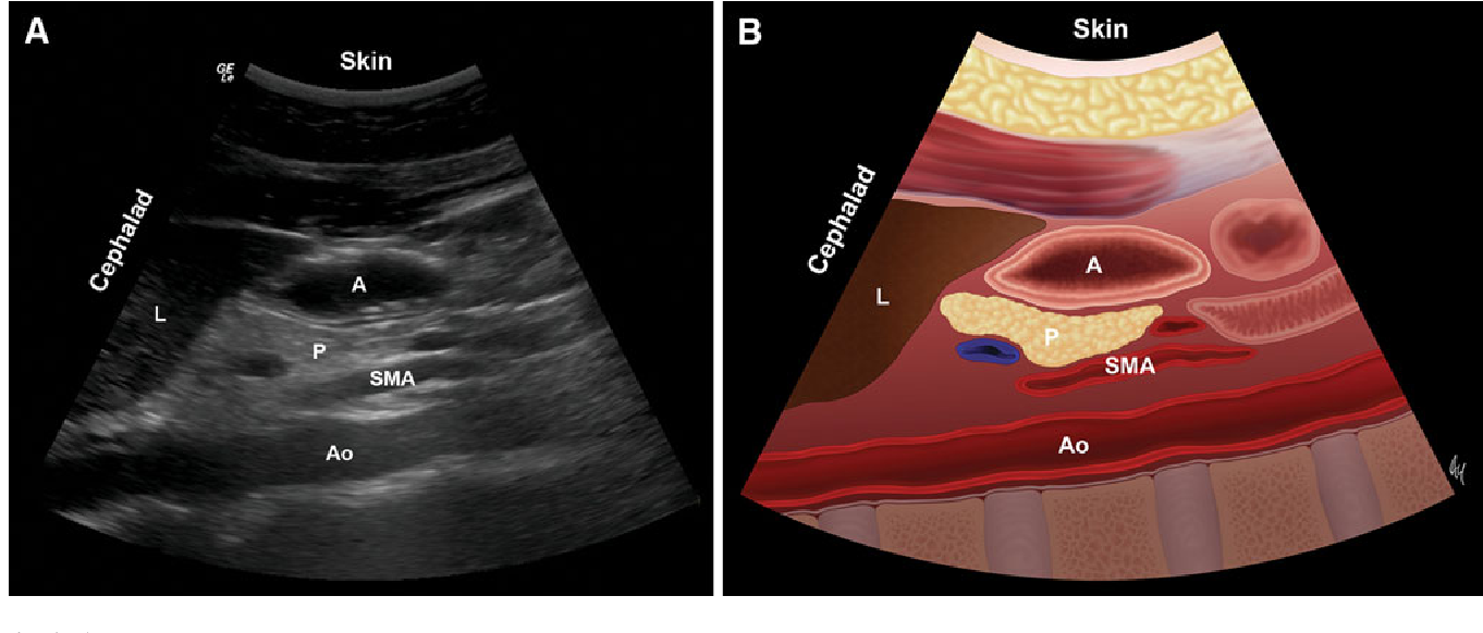 The major goal of point-of-care (POC) gastric ultrasound is to assist doctors in assessing gastric contents when NPO status is unclear or uncertain during the pre-anesthetic phase.